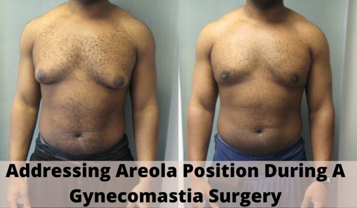 Addressing Areola Position During A Gynecomastia Surgery