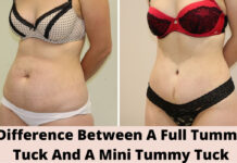 Difference Between A Full Tummy Tuck And A Mini Tummy Tuck