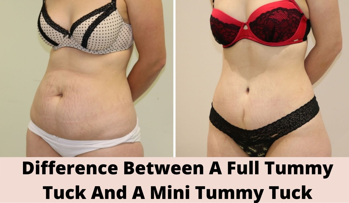 Difference Between A Full Tummy Tuck And A Mini Tummy Tuck